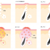 口の周りにできる白ニキビを防ぐには