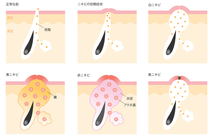 白い ニキビ ニキビの白い膿の正体はなに？出すのは？