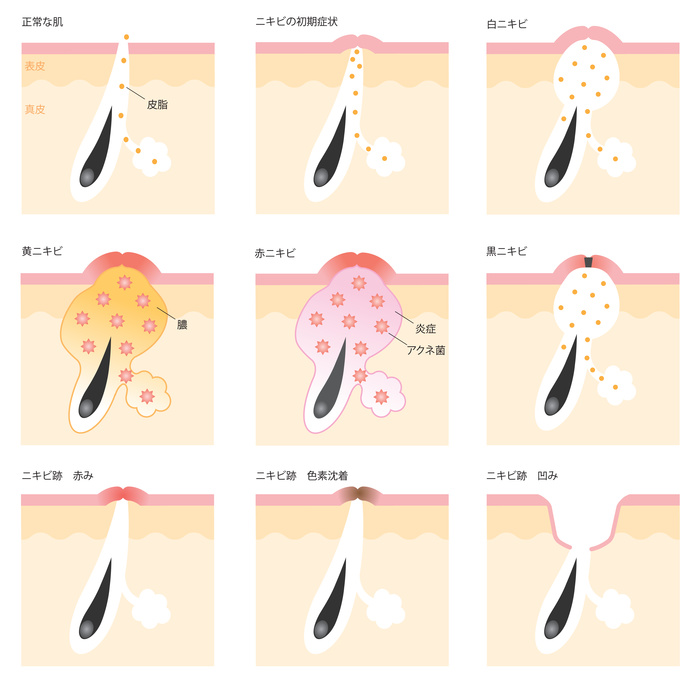 ニキビの種類