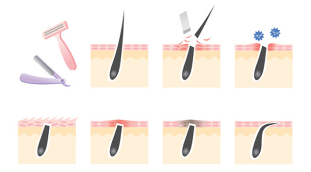 カミソリの原因