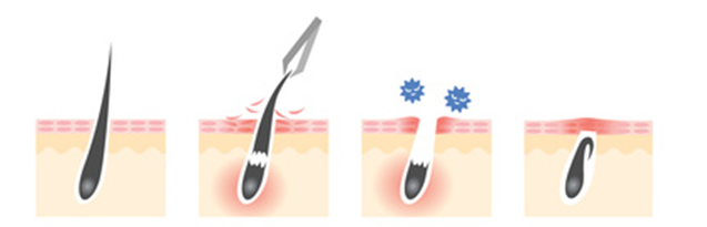 毛抜きの原因